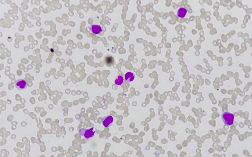 Chimeric Therapeutics ASX CHM 0201 cell study treatment acute myeloid leukaemia AML MD Anderson Cancer Center